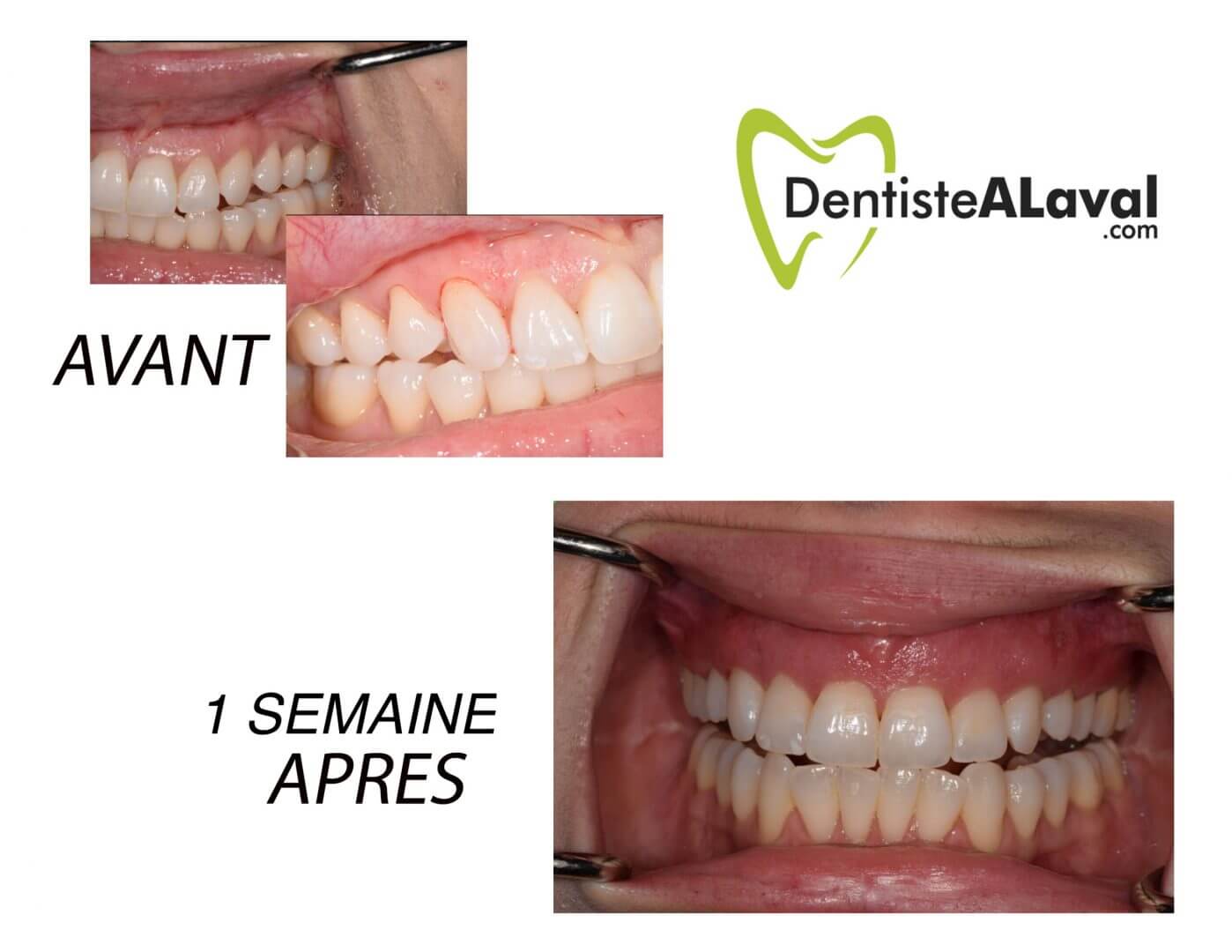 Pinhole Surgical Technique (PST), what is it exactly? DentisteAlaval