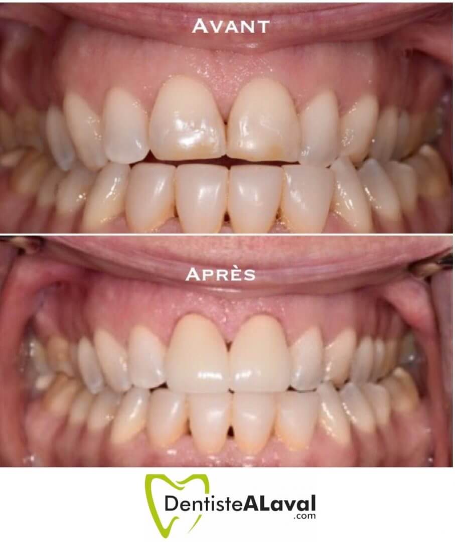 couronnedeporcelaine-laval-dentiste