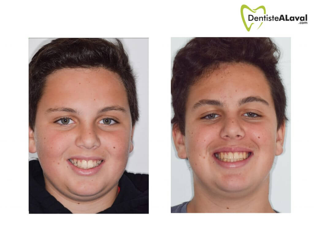 before after invisalign